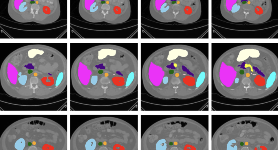 Oxford researchers unveil MedSAM-2, an AI that could change how doctors analyze medical images