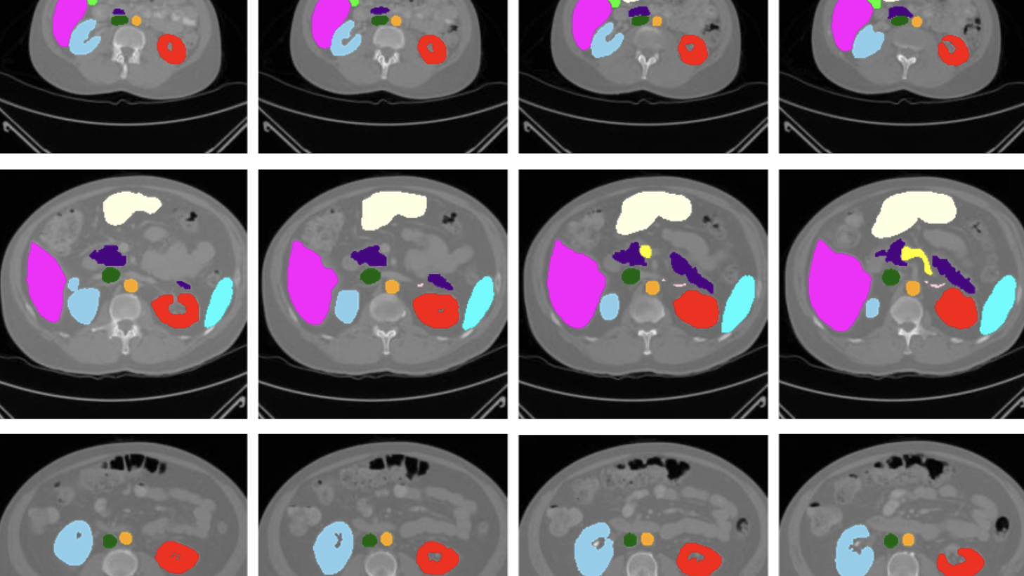 Oxford researchers unveil MedSAM-2, an AI that could change how doctors analyze medical images